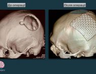 Врачи больница Мечникова спасли больного с дефектом черепа